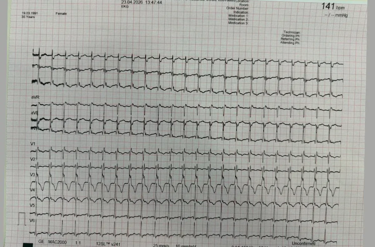 Kontrolni EKG nakon uspješne konverzije ritma — stabilan sinusni ritam sa frekvencom 71 otkucaj u minuti