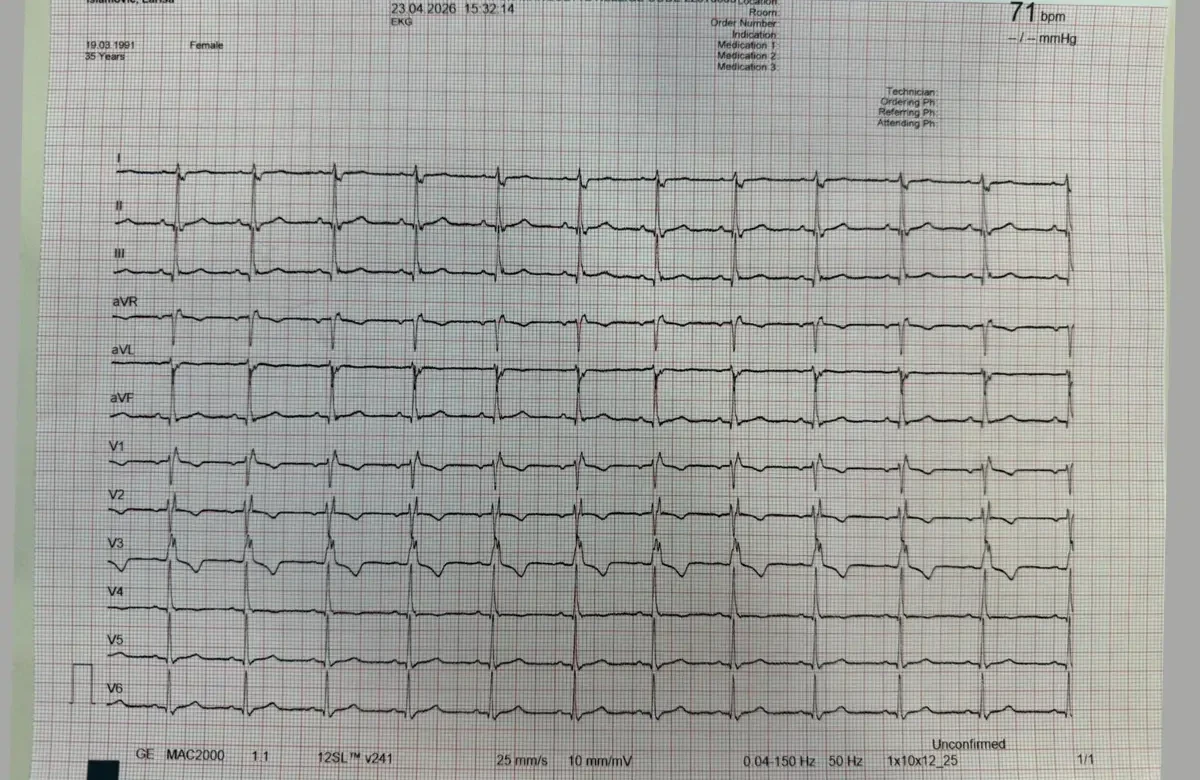 EKG nalaz supraventrikularne tahikardije sa frekvencom 141 otkucaja u minuti, uski QRS kompleksi, regularan ritam